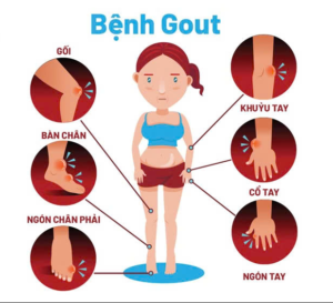 Các vị trí bệnh gout thường gặp – Nguyên nhân, triệu chứng và điều trị