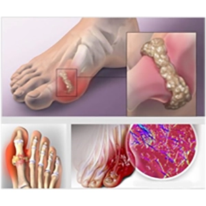 dau hieu gout giai doan nang 1